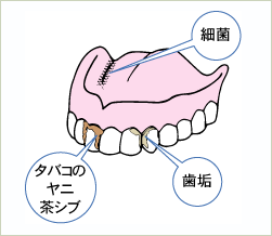 インプラント